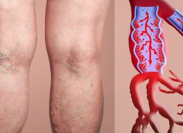 Understanding the Risk of Deep Vein Thrombosis in Seniors